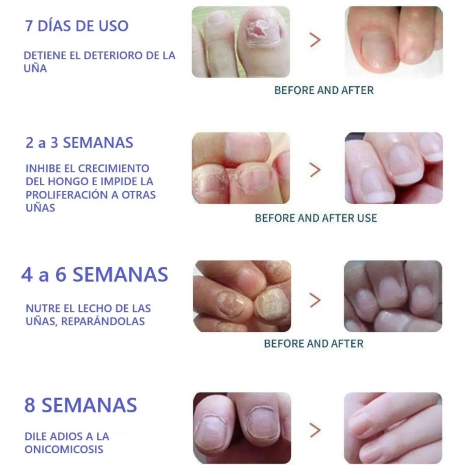 Parches para hongos de uñas x10 pcs. - Imagen 2